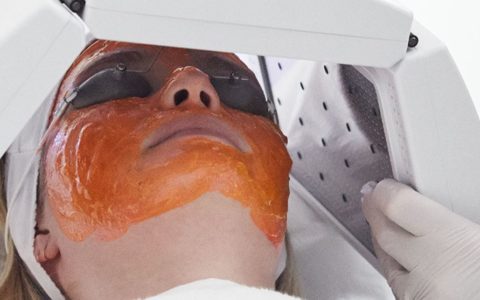Kleresca® Acne Treatment