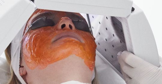 Kleresca® Acne Treatment