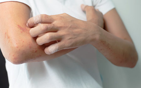 Soothe and heal your urticaria (hives) with these proven treatments