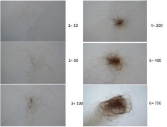 How To Tell If Your Losing Too Much Hair Sinclair Dermatology