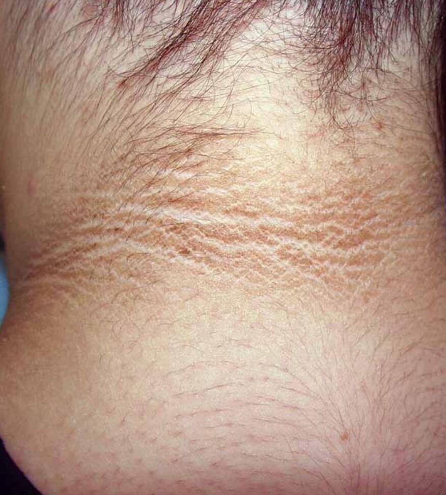 disorders of pigmentation