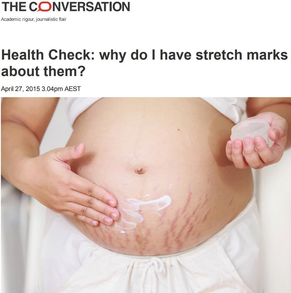 stretch marks