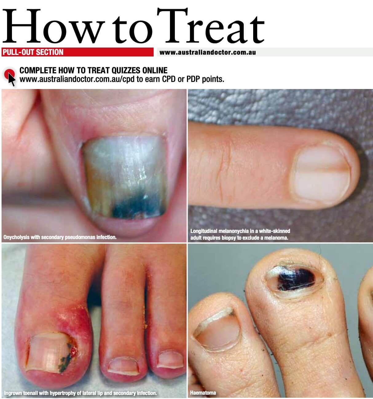 ten important nail disorders