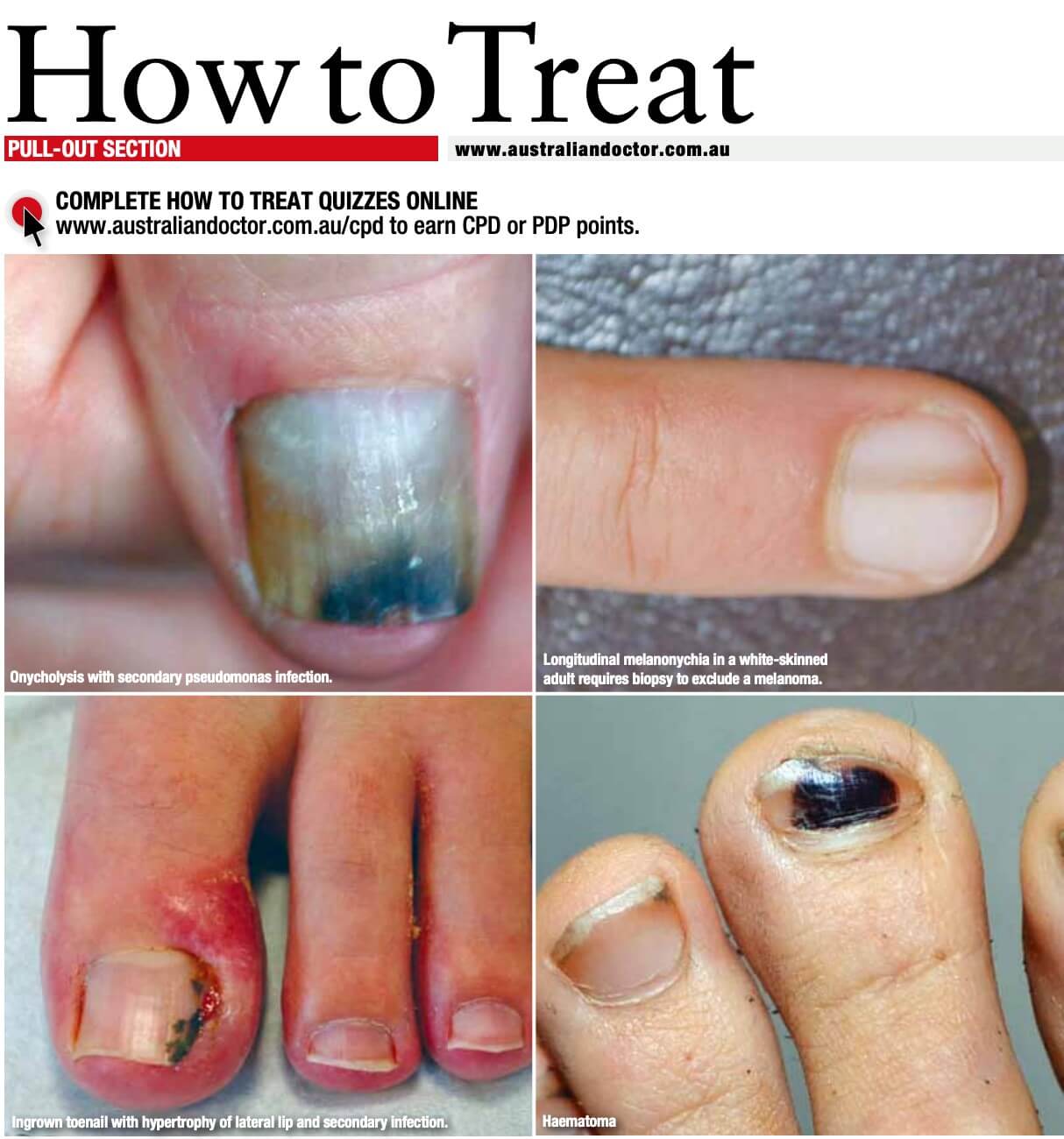 Dermoscopic Features of Green Nail Syndrome Associated with Dermatophytosis  and, Traumatic Onycholysis