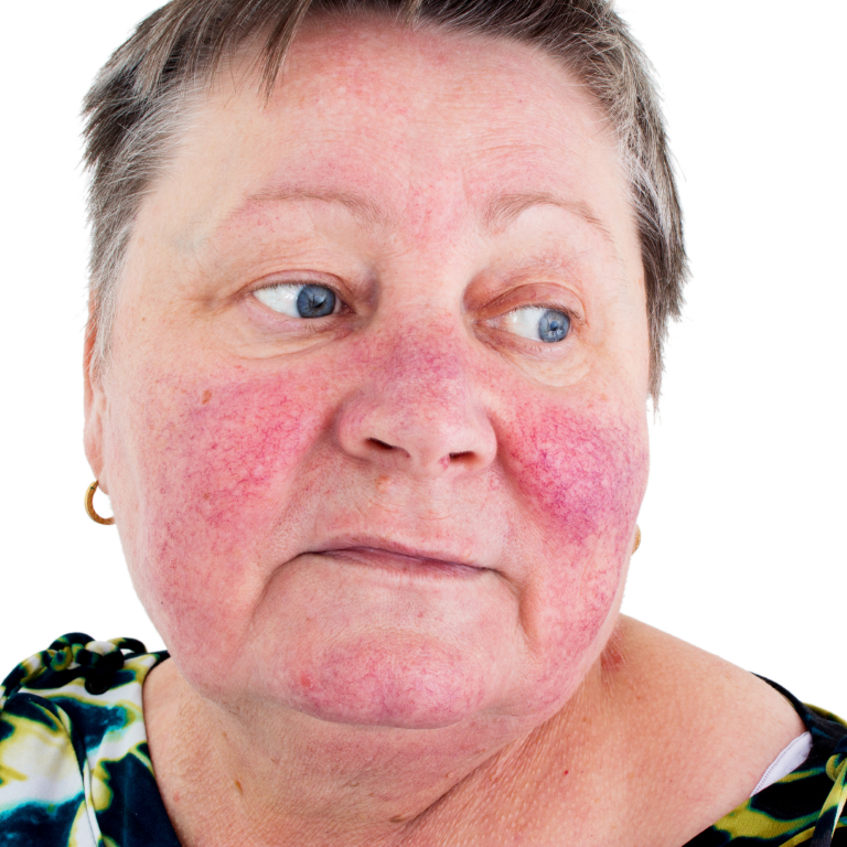 Rosacea