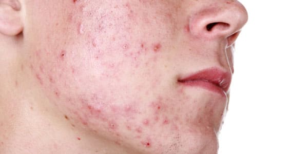 acne scarring