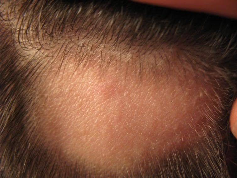 alopecia areata treatment