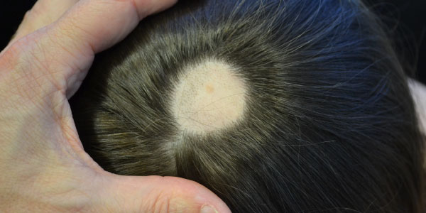 alopecia areata