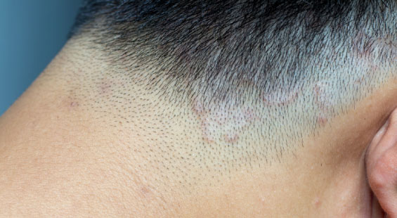 hair infections hair loss treatments