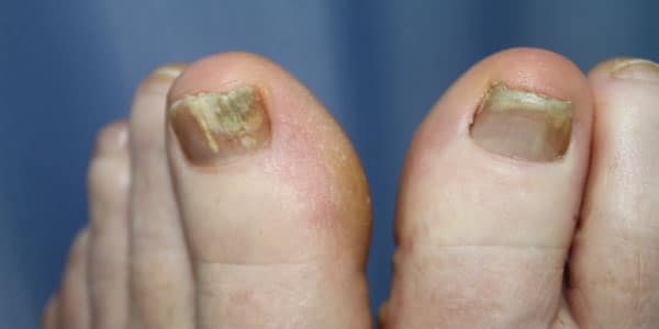 Are You Seeing Holes & Dents In Nails? Read This!