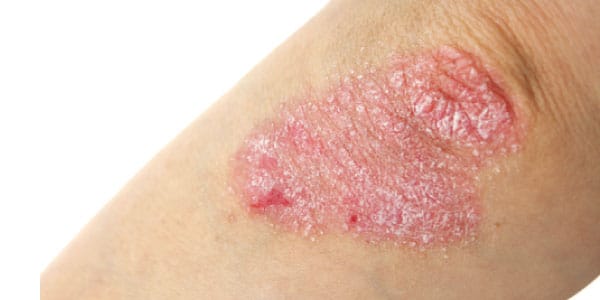 psoriasis