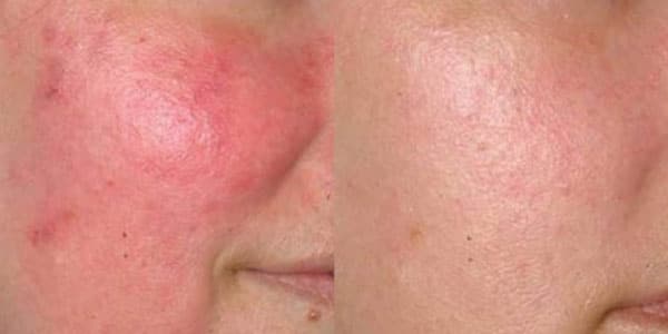 rosacea