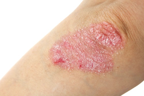 psoriasis clinical trial