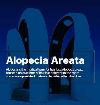 alopecia areata