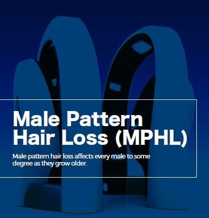 male pattern hair loss