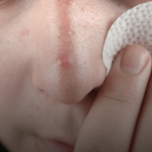 Treating chronic skin conditions