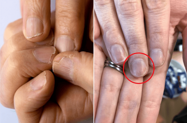Varied Colours Of The Nail: Know What They Indicate About Your Health?