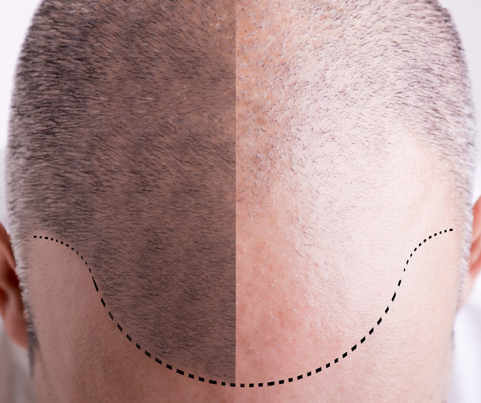 Patterned Hair Loss Treatments Melbourne | Sinclair Dermatology