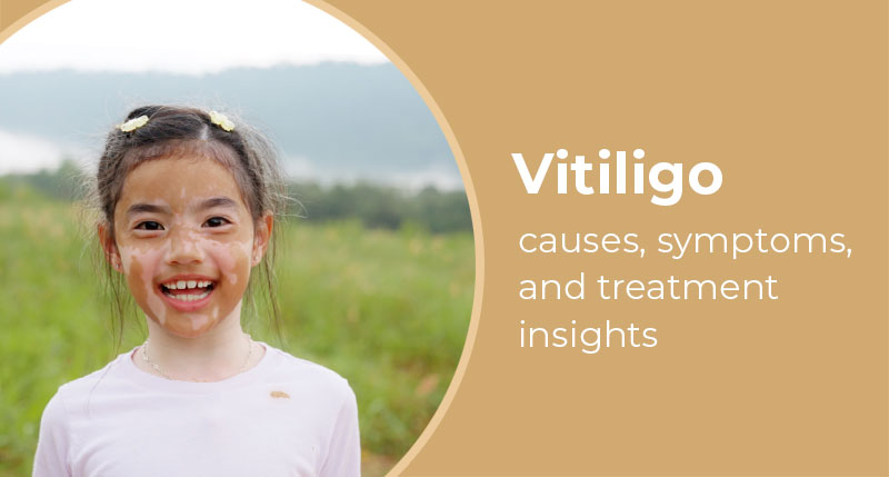 Vitiligo causes, symptoms, and treatment insights