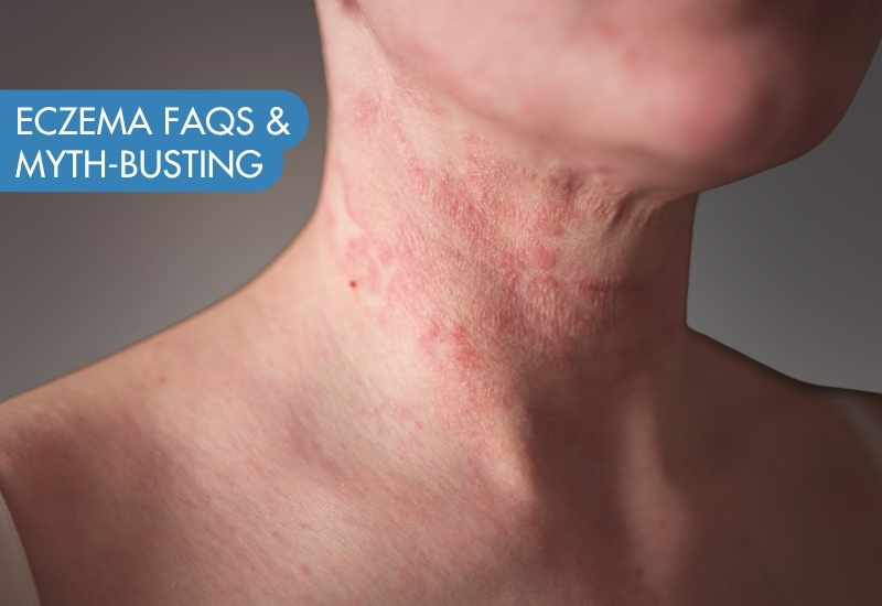 Eczema