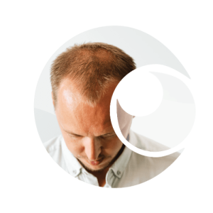 Male Pattern Baldness Clinical Trial