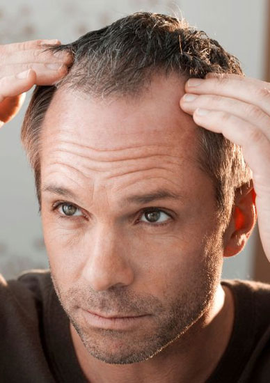 Hair Transplantation