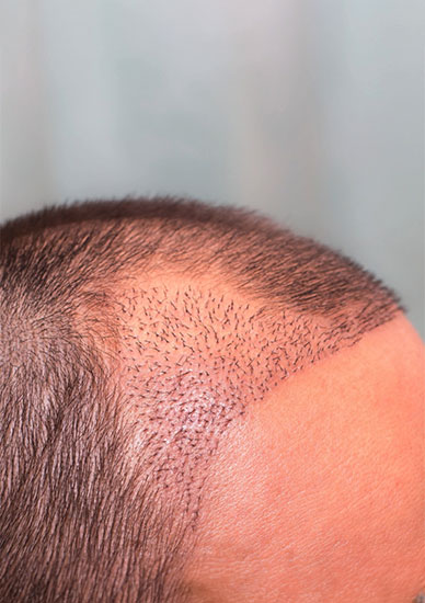 Hair Transplantation
