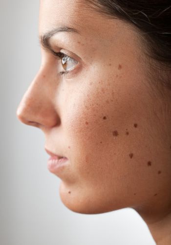 Skin cancer risk factors