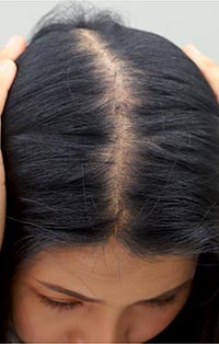Androgenic alopecia
