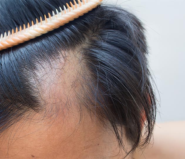 Female pattern hair loss