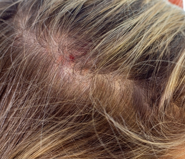 Hair and Scalp disorder