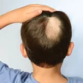 Alopecia.Areata.Young_.Boy_G