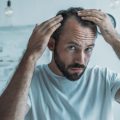 Androgenetic alopecia (Hair Loss) Androgenetic alopecia (Hair Loss)
