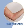 Urticaria (Hives)